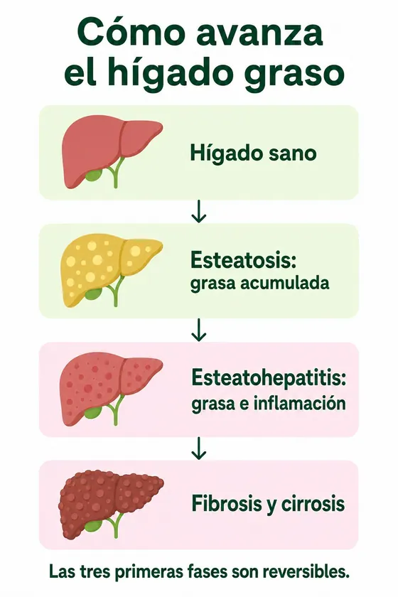 Infografía de cómo avanza el hígado graso: hígado sano, esteatosis (grasa acumulada), esteatohepatitis (grasa e inflamación) y fibrosis y cirrosis. Las tres primeras fases son reversibles.